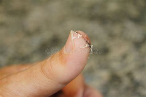 Wound Stitches Finger Stock Photos - Free & Royalty-Free Stock Photos ...