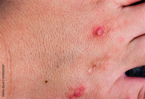 Hand, foot, and mouth disease rash on child hand. Stock Photo | Adobe Stock