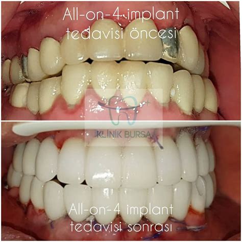 Klinik Bursa Ağız ve Diş Sağlığı Polikliniği - Büt…