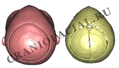 Тригоноцефалия – craniofacial.ru