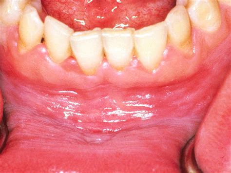 White gums: Causes, symptoms, and how to get rid of them