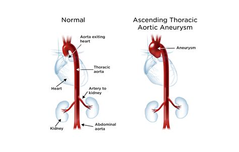 Aortic Aneurysm | My Doctor Online