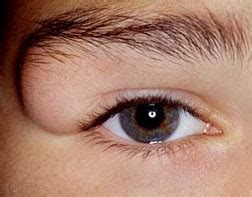 Soft Bump On Eyelid