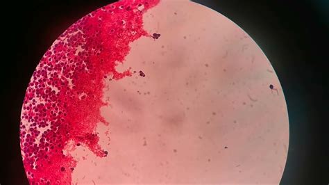 A closer look of Candida albicans gram stain|MEDICAL LABORATORY SCIENCE ...