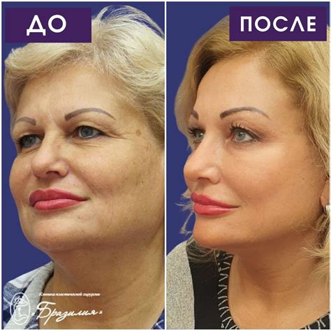Фейслифтинг