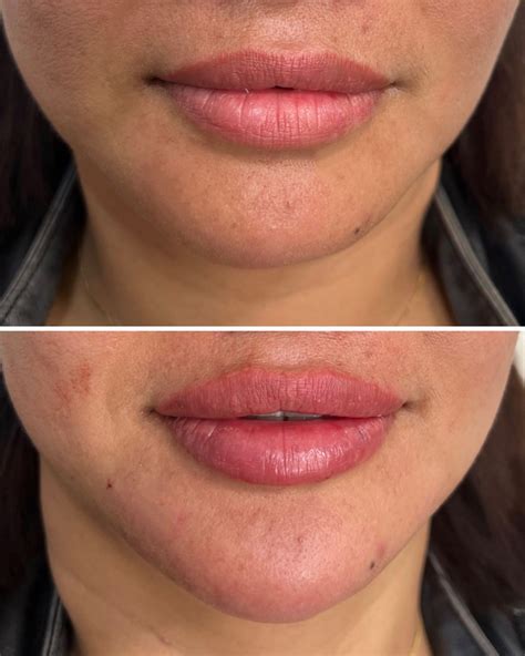 Chin Filler: A Comprehensive Guide