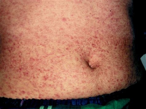 Viral Rash In Toddlers
