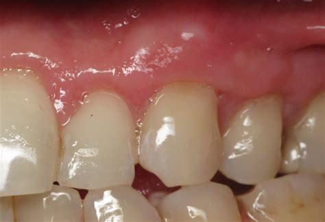 Thin Receding Gums And Dental Implants – What's Important? Video by ...