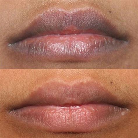laser lip lightening effects cost risks lip lightening dark lips