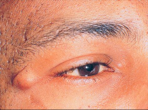benign eyelid lesions clinical tree