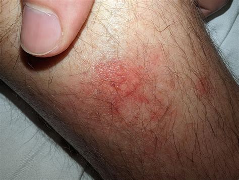 Extremely itchy bug bite in southern Japan with other symptoms. : r ...