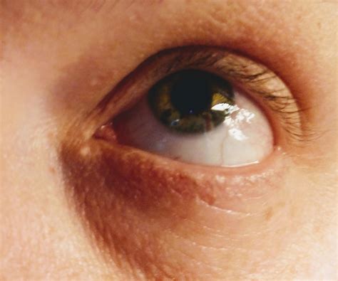 Any idea what the white spot is in the inner corner of my eye? It's