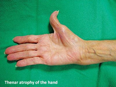 Thenar atrophy of the hand - SGH.