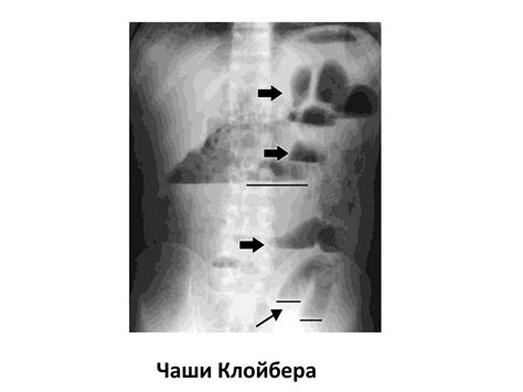 Острая кишечная непроходимость - презентация онлайн