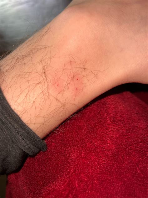 Was mowing my lawn two or three days ago and noticed these bites on my