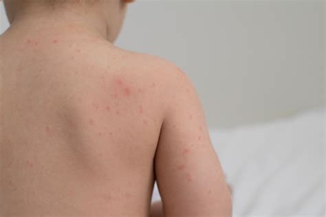 penyebab  ciri ruam dbd  bayi   mengatasinya