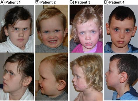 Facial appearance of Patient 1 at the age of 13 years (A), Patient 2 at ...