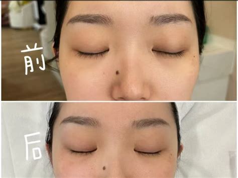 pico  laser dark circle removal skin color tone improvement face