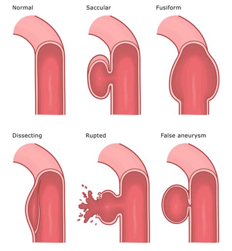 Unruptured Aneurysm Definition | Supreme Vascular and Interventional Clinic