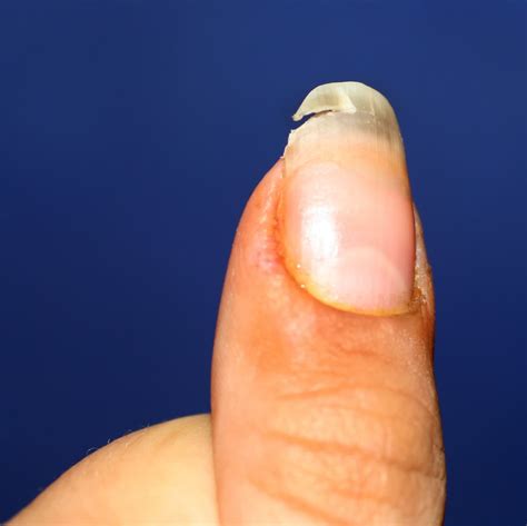 How To Fix A Broken Nail Without Tea Bag And Glue at Armand Hudson blog