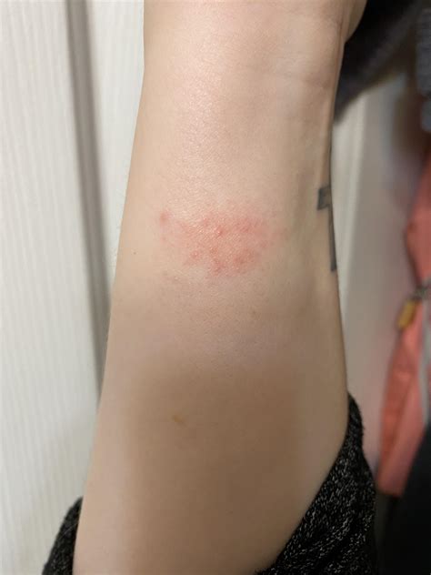 Itchy Rash On Top Of Wrist at Charles Honig blog