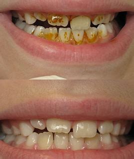 лечение на кариеси детски | kunevadental