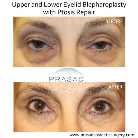 Ptosis Surgery | Eyelid Droop Correction New York - Amiya Prasad MD