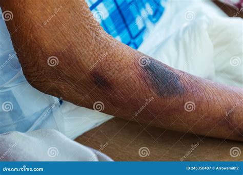blood bruises   skin   elderly patient stock image image