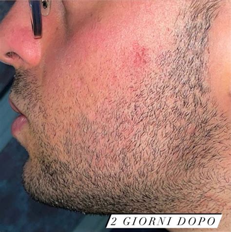 Rimozione cicatrici da Acne a Cosenza - Centro Laser Metropolis