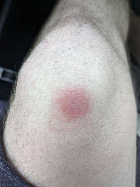bug bite and red line 2