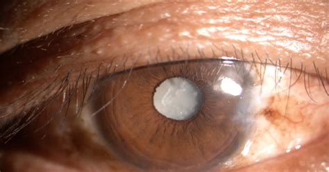 mengenal penyakit mata katarak  persiapan pasien  operasi