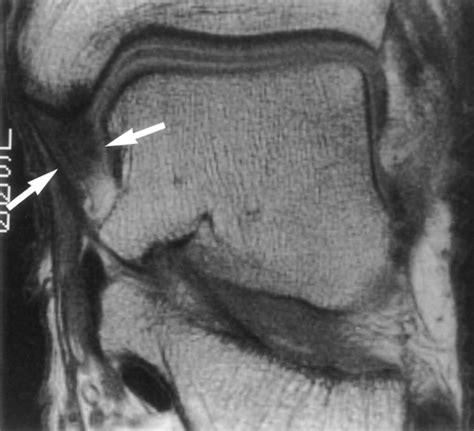 MRI Musculo-Skeletal Section: Deltoid ligament injury.