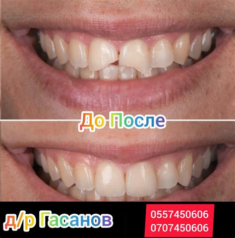 Циркониевые коронки | Medportal