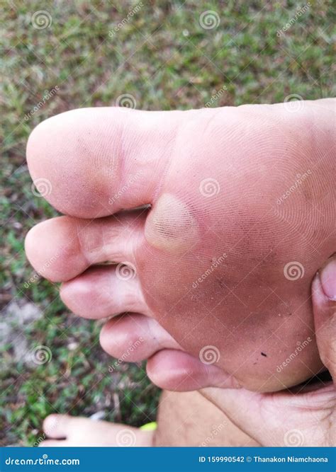 feet swelling  walking  shirley roache blog