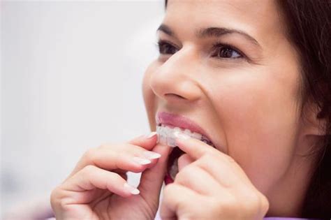 Научете повече за лечението с алайнери | Deckoff Dental