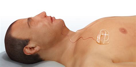 Inspire Implant for Obstructive Sleep Apnea in Patients Who Do Not ...