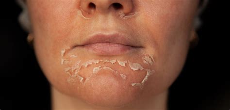 Face Chemical Peel Mask at Carolyn Hudson blog