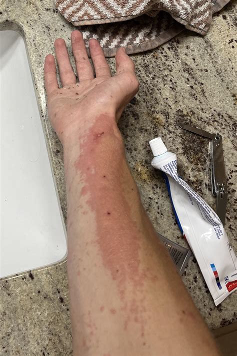 What a case of Black Spot Poison Ivy Dermatitis looks like one day
