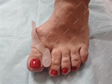 Premium Photo | Bare foot with bursitis hallux valgus problem