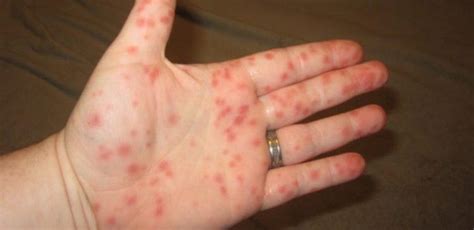 What to Do If You Notice Red Spots on Your Child - 100 Yummy