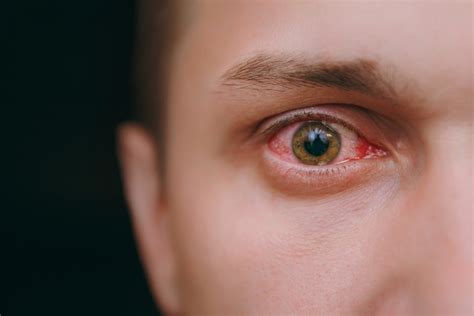 Smoking Weed Eyes Red High Eyes | Causes, Symptoms, And How To Address