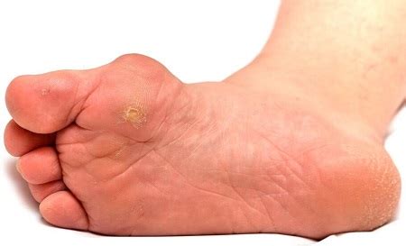 small bumps  foot  skin clearance emergencydentistrycom