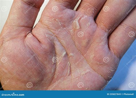 Palm Peeling Eczema Skin Disease Stock Image - Image of disease, palm: 235827843