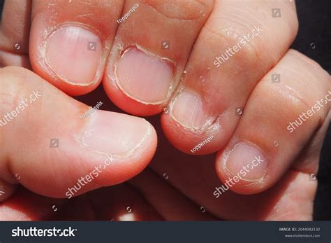 Closeup Deformed Nails Human Nail Biting Stock Photo 2044082132 ...