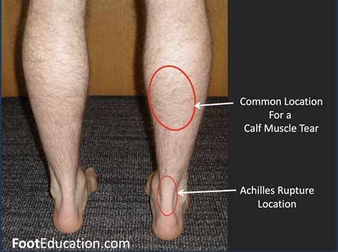 Calf Tears, Achilles Ruptures, Achilles Tendonitis, and Plantar