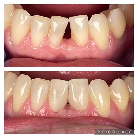 Smile Gallery | Dublin Family Dental | Dentist in Dublin, CA 94568