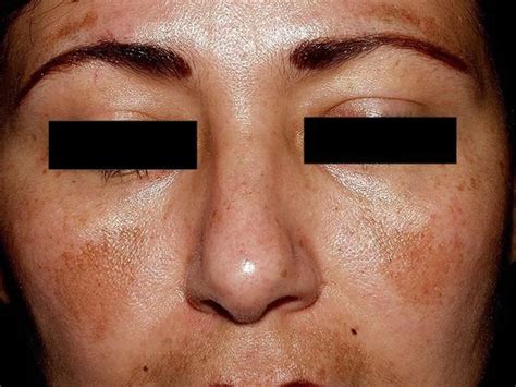 Melasma causes, symptoms, diagnosis & best treatment for melasma on face