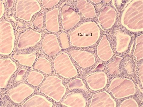 Normal Thyroid Follicular Cells – My Endo Consult