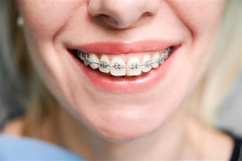 Braces-Friendly Foods: To Include and Avoid for Best Results