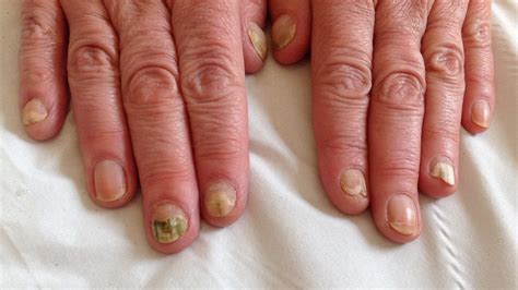 Fungal Fingernail Infection